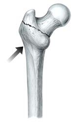 Step 1 Using an osteotome, mark on the lateral cortex of the femur the required point of entry for the guide pin.