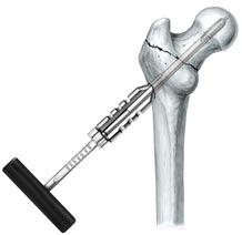 Step 5 For hard, dense cancellous bone it may be necessary to cut the screw thread with a tap.