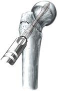 Step C Screw the lag screw into the femur until the 0 mark on the wrench reaches the end of the centering sleeve.