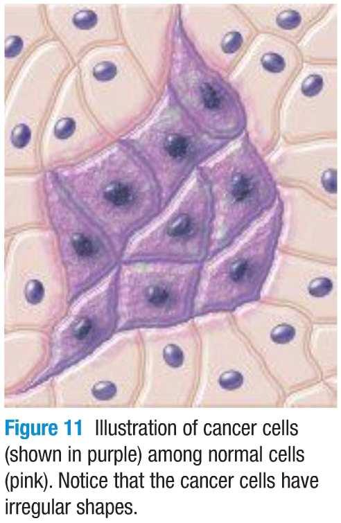 MALIGNANT TUMOUR interferes with the work of the cells around it or destroys them are cancerous dangerous because their cells can break away and travel to another part of the body where they start a
