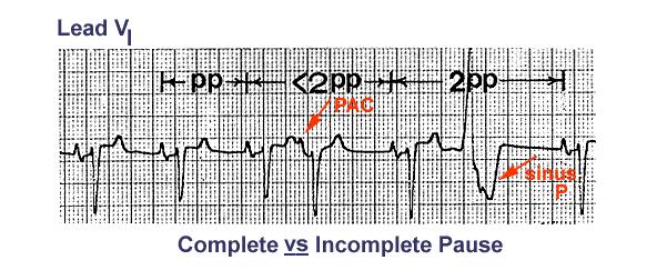 Premature Atrial Contraction The ectopic P wave is