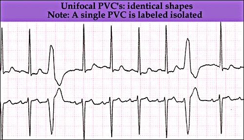 Premature Ventricular Contractions Unifocal or