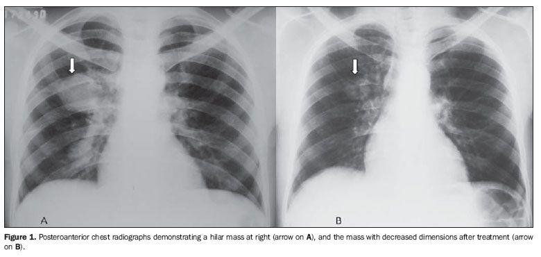 Differential Diagnosis PULMONARY ARTERY ANEURYSMS (PAA) A PAA is a focal dilation of all three