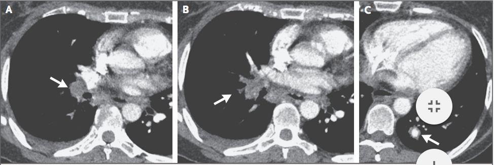 Patient History: 12 months prior Patient still had persistent cough and dyspnea (labored breathing) upon exertion CT scan of chest was performed Pulmonary embolism in the right lung, occlusion of