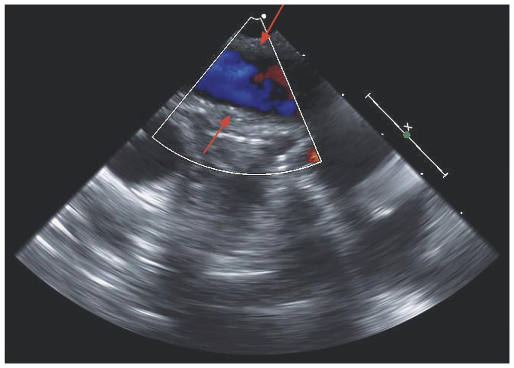 Intraoperative Course Transesophageal echocardiography performed before the thromboendarterectomy procedure showed a mass in the proximal portion of the right pulmonary artery (diagram on right)