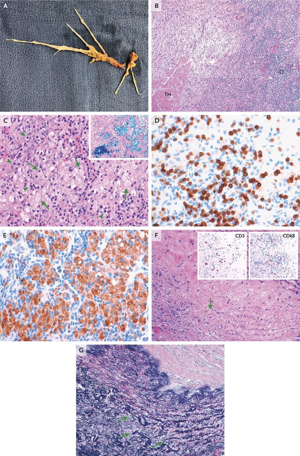 Pathological Discussion The biopsy specimen (Panel A) included organizing thrombus and inflammation which in turn included Tlymphocytes, hemosiderin-containing macrophages, and some plasma cells No