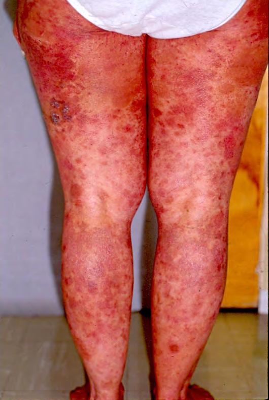 Adult-onset recalcitrant eczema: A possible marker for