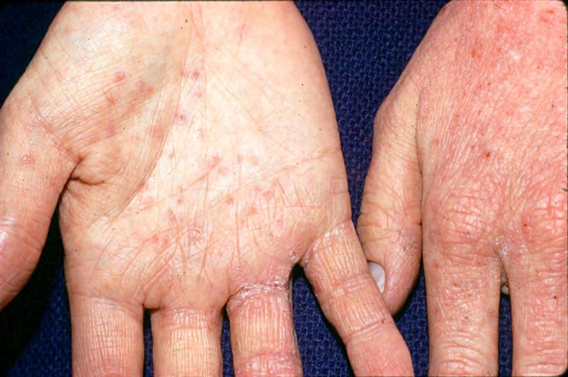 Hand Eczema & Eyelid Dermatitis ACD or AD?