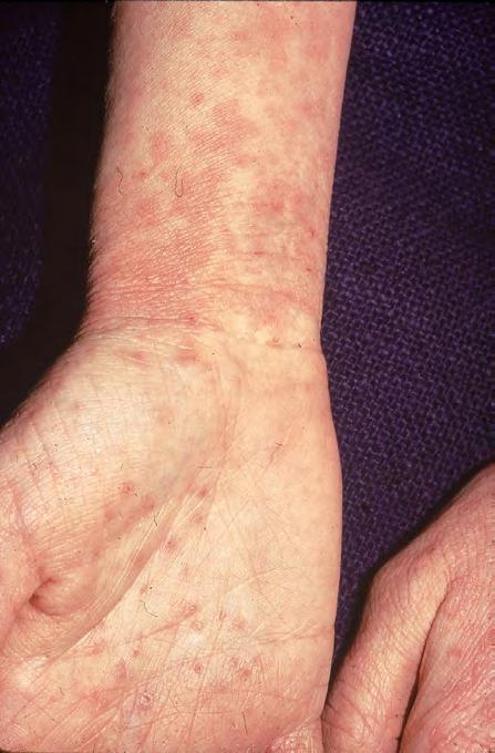 Case Finding for Adult Onset AD Sensitive skin? Infant or early childhood eczema?