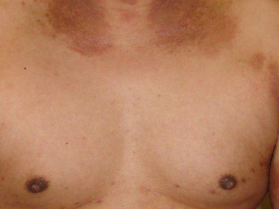 30 yo Asian/American man Flaring of chronic AD with lichenification, pigmentation and itch using only Cetaphil cr Similar presentation 3 yrs ago; responded
