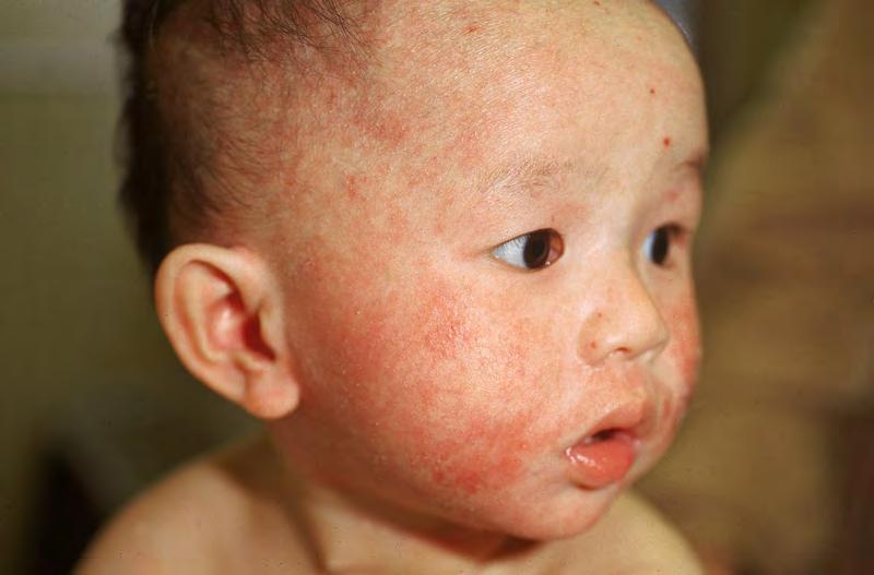 Atopic Dermatitis and Allergy AD is not an IgE-mediated disease AD is not