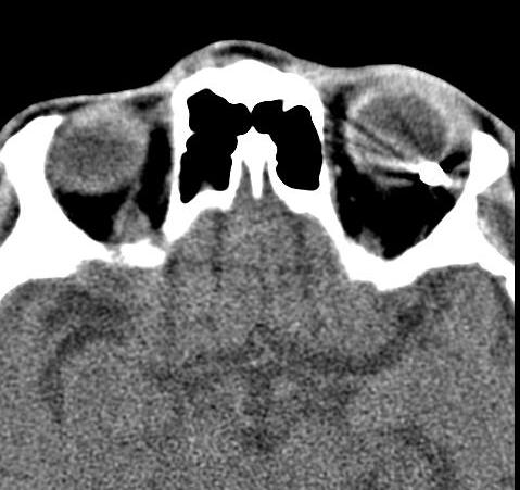 Incremental CT image