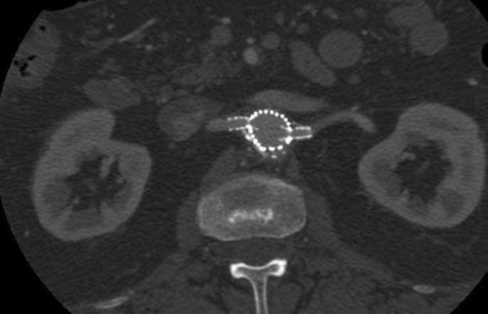 Multislice CT ngiography of Fenestrated Endovascular Stent Grafting for bdominal ortic neurysms design options for the types of fenestrations employed in this study.