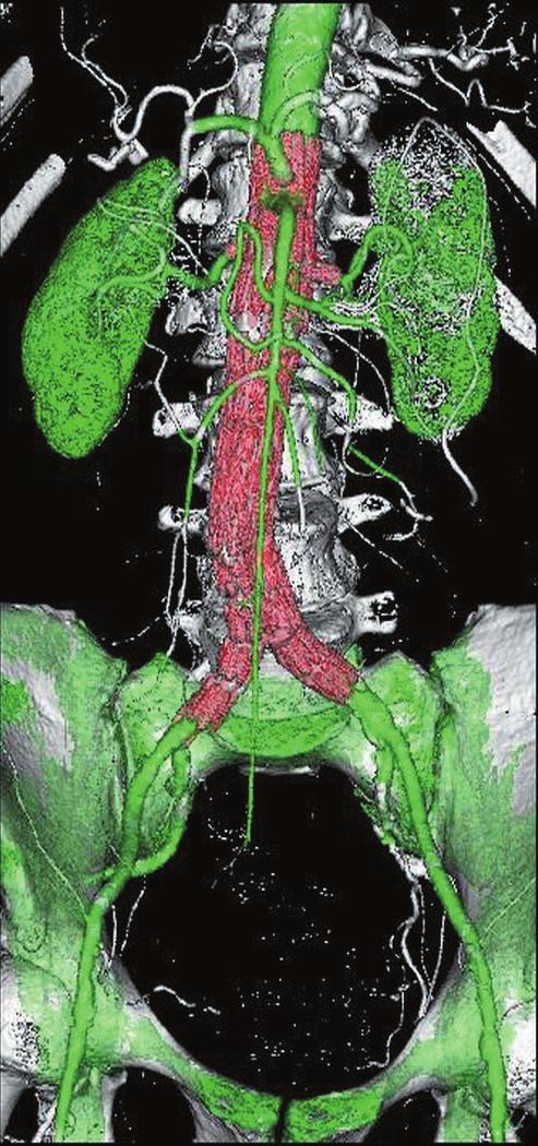 nother limitation of MPR is that a number of reconstructed views are required to demonstrate the entire aortic aneurysm and the vessel branches (8).