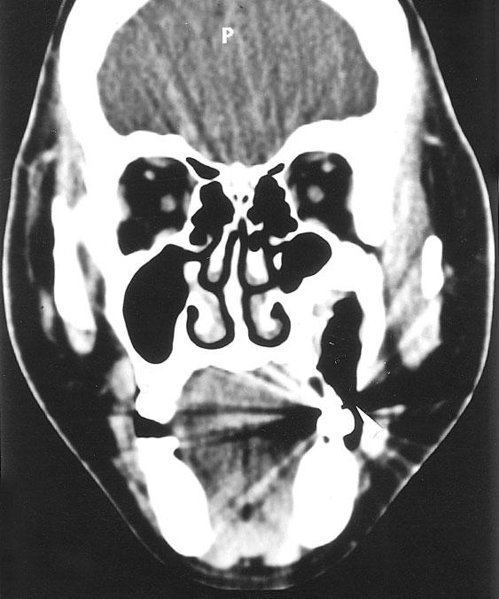 10 Paranasal sinuses 39 cuts, the MSAD is instead higher than that with171 mas and 20 thicker slice. Thus, this condition also is inproper for thin slice scan.