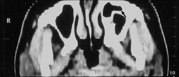 MPR shows the reconstructed arrowy image of bone contrast and the fistula between left nonnasality and paranasal sinuses (marked with arrow). Figure 5.