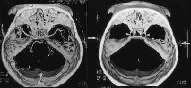 A B Fig. 2. Patient 11. Brain death caused by hypoxic brain damage in a 38-yearold man. A. CT angiogram with shaded-surface-display at the day of admission shows preserved cerebral flow.
