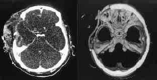 Axial source image at the level of circle of Willis (A) and CT angiogram with shaded-surface-display (B) at the day of admission show opacification in the thin and elongated anterior cerebral