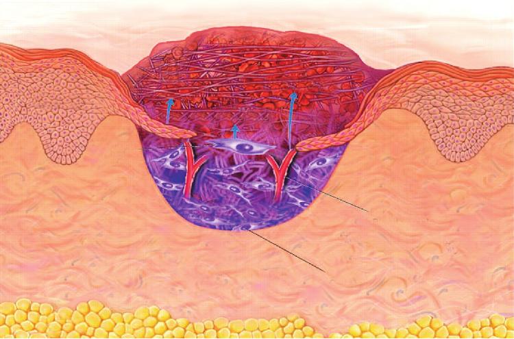 3 Illustration of a full thickness cutaneous wound showing the cellular and molecular components present 3 days after injury.