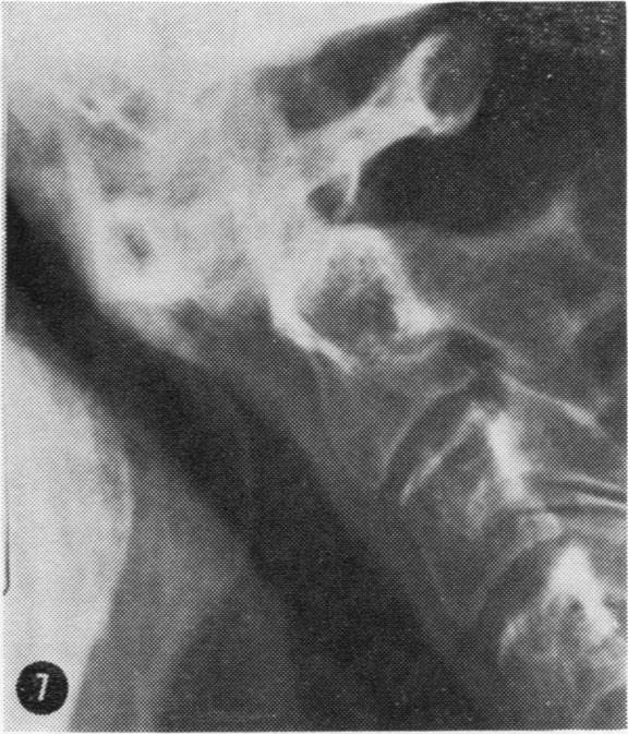 Cervical collars in rheumatoid atlanto-axial subluxation 487 Table 1 Degree (mm between atlas and odontoid process) of atlanto-axial subluxation in flexion and extension in 11 patients with