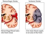 Ischemic Strokes: Embolic Watershed