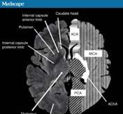 Anatomy Middle Cerebral Artery Infarction: M2 Inferior Division Affecting the lateral parietal, temporal and occipital lobes. Dominant Hemisphere: Wernicke s aphasia and contralateral hemionopsia.