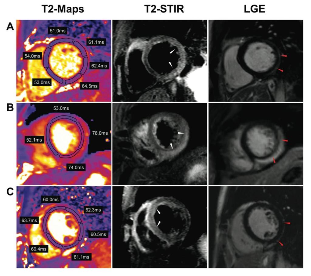 LGE Native T2 mapping offers a robust alternative to standard T2 or LGE imaging