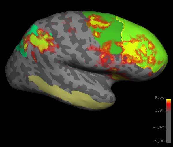 IPS (intraparietal sulcus) Sternberg Task: Group analysis (n=10) HIGH (5) LOW(1) Working Memory Load: Green regions: ROIs of 3 working memory related areas (DLPFC, DLPMC, IPS) and 1 control region