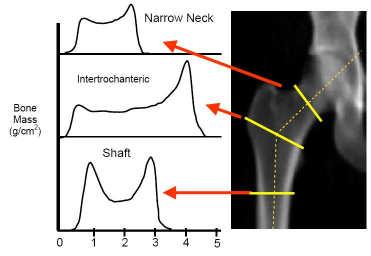 Non-invasive Imaging Approaches Geometry DXA-based Hip Structural Analysis (HSA) Estimating Hip Geometry from 2D DXA Hip Structure Analysis (HSA) Use 2D DXA-data to derive 3D geometry Many HSA
