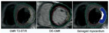 T2 CMR Myocardial Salvage in Retrospection Salvageable myocardium = T2 area