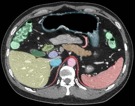 Axial Image 3 Duodenum 2 Stomach Splenic