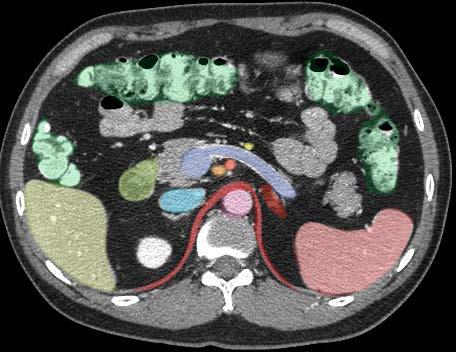 Axial Image 6 Left gastric Portal
