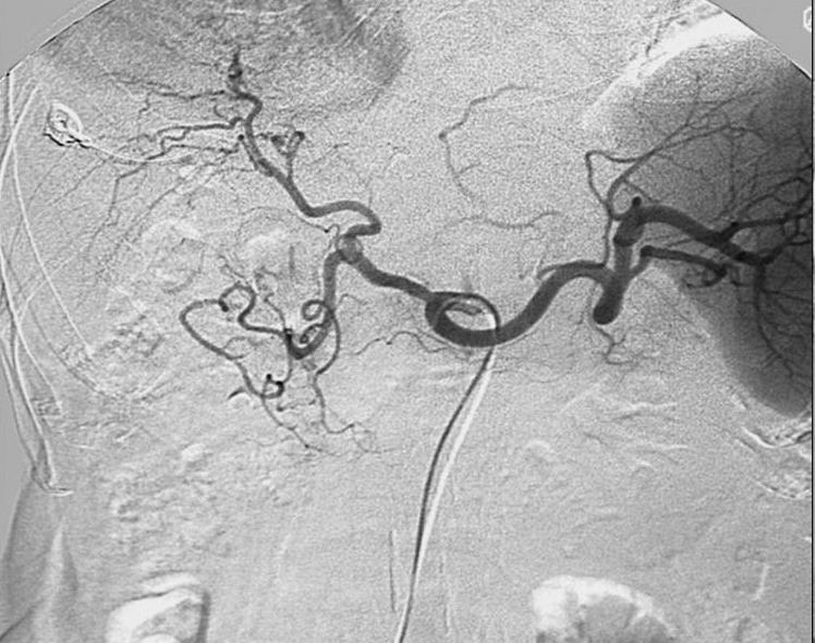 Celiac Artery Digital Subtraction Angiography (DSA) Celiac trunk Common