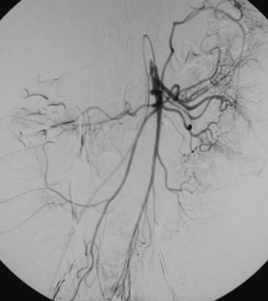 mesenteric artery Right colic artery Ileocolic