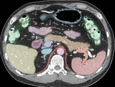 Axial Image 4 Jejunum Duodenum 2 Pancreas Portal vein