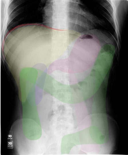 Abdominal Radiograph (aka KUB) KUB = frontal supine abdominal radiograph;