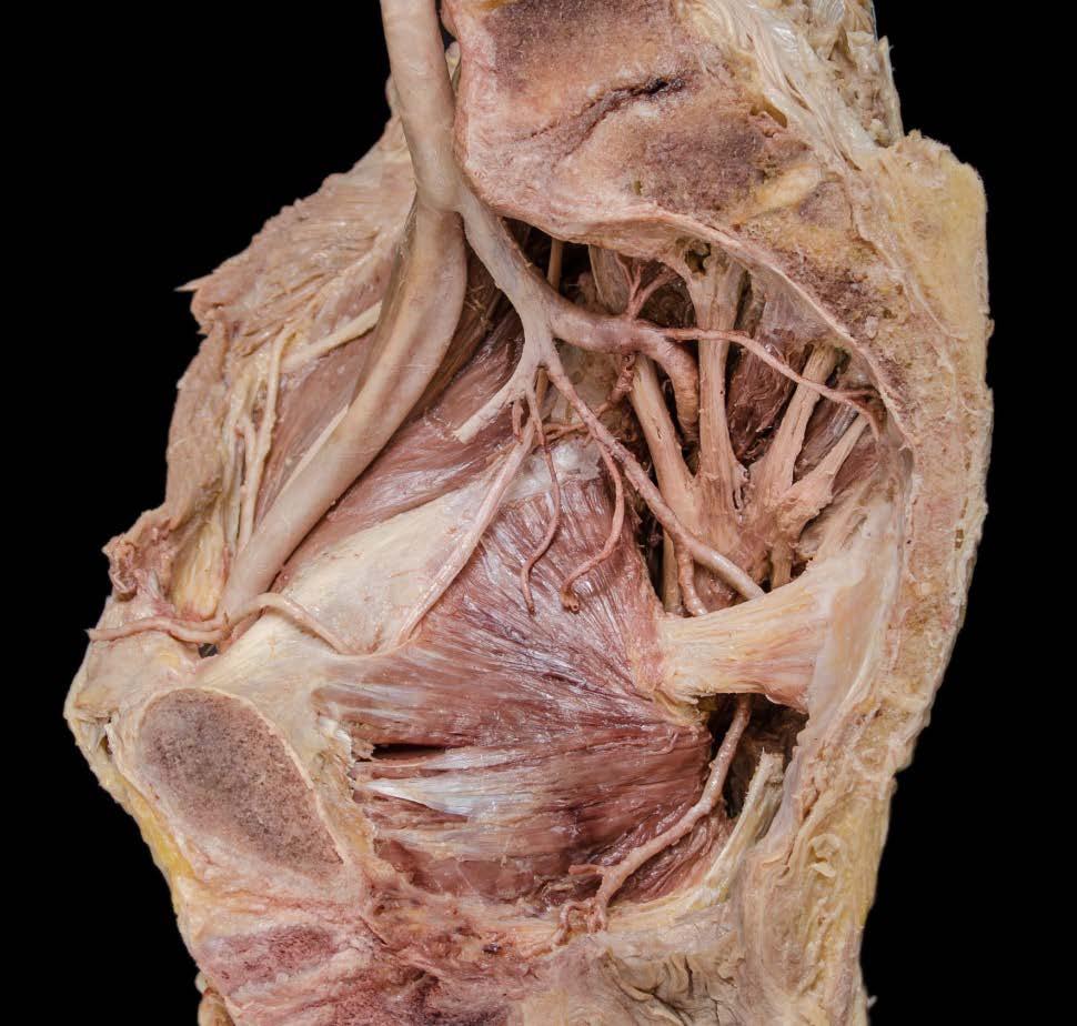 Internal Iliac Artery