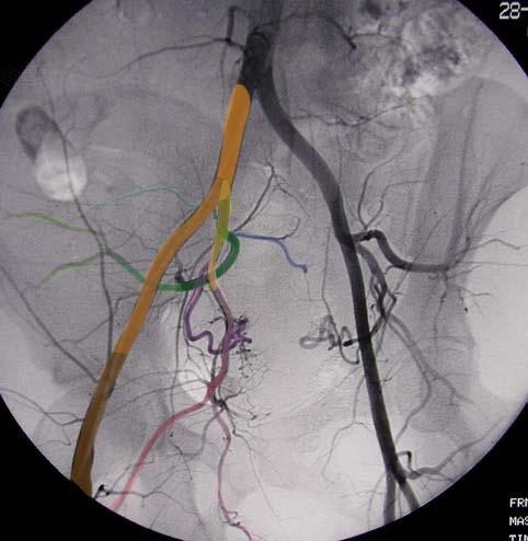 Common iliac artery Internal iliac artery Internal Iliac Artery Branches Pelvic Angiogram - Female