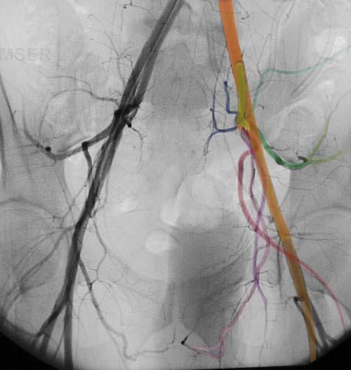 Internal Iliac Artery Branches Pelvic Angiogram - Male Common iliac artery Internal iliac artery