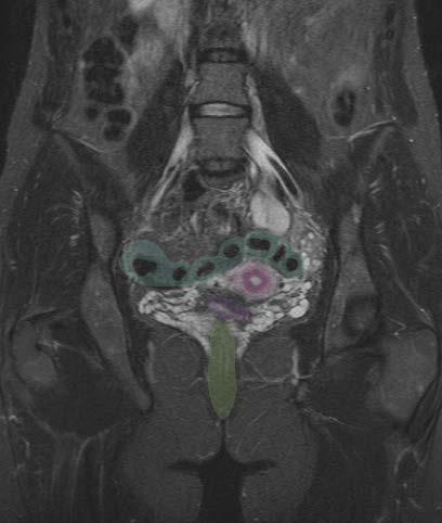 Coronal MRI - Female Coronal MRI -