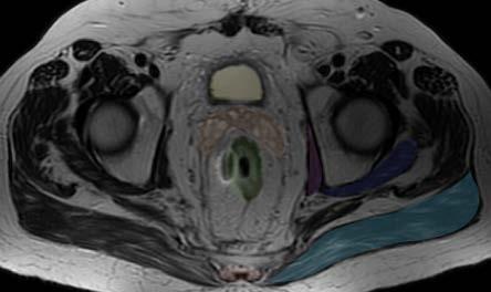 Axial MRI - Male Axial