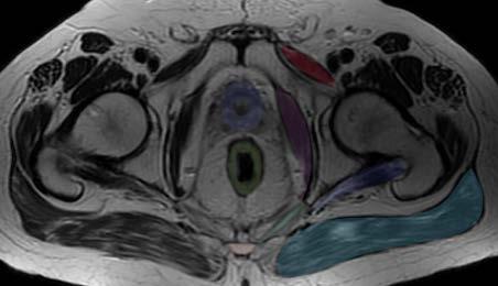 Axial MRI - Male Axial MRI -