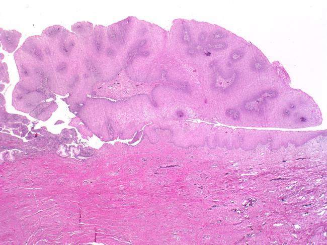 Diseases of penis, Condyloma Acuminatum A benign tumor *Tend to recur but only rarely progress into in situ or invasive cancers read this = genital