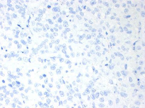 Tumor Differentiates to form structures typical of the embryonic