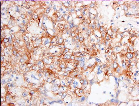 one study 7 of 45 glandular tumors reclassified as glandular yolk sac tumors 26/76 sarcomatoid tumors