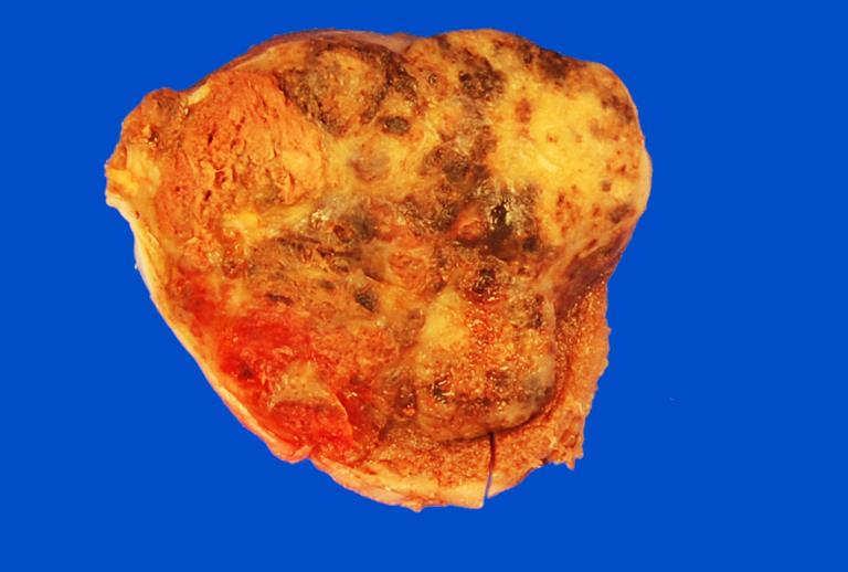 Choriocarcinoma Less than 1% of testicular tumors.