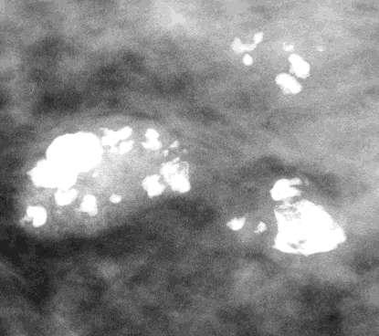 Carcinoma and Calcification Not all irregular calcifications represent carcinoma Tissue necrosis happens in