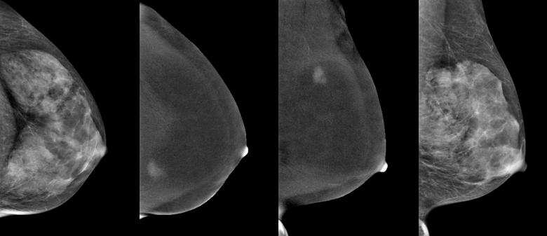 Figure 4b: Ultrasound of the left breast of same patient.