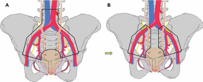 4-6 A larger limited lymphadenectomy template (referred to as standard by some) is bounded distally by the circumflex iliac vein and Cloquet s node, laterally by the genitofemoral nerve, medially by