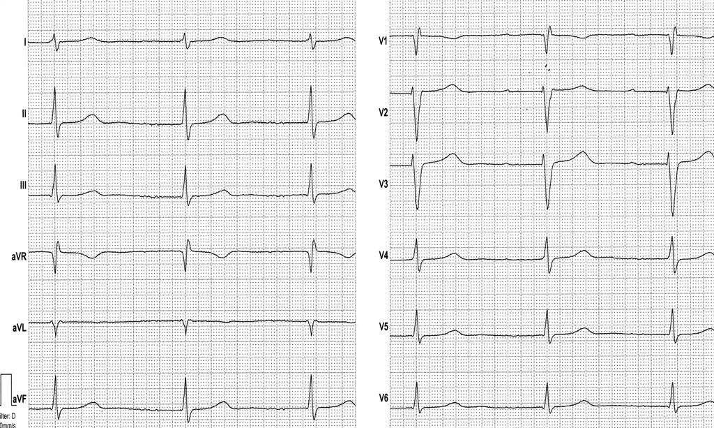 female, 33ys, presenting with paroxysmal AF, family history of AF and SCD pathognomic flat P waves prolonged PQ narrow QRS typical